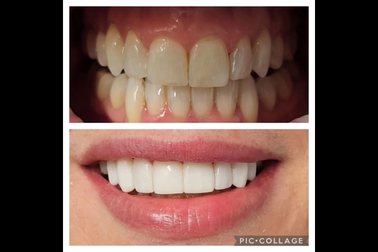 Teeth Whitening in Stafford