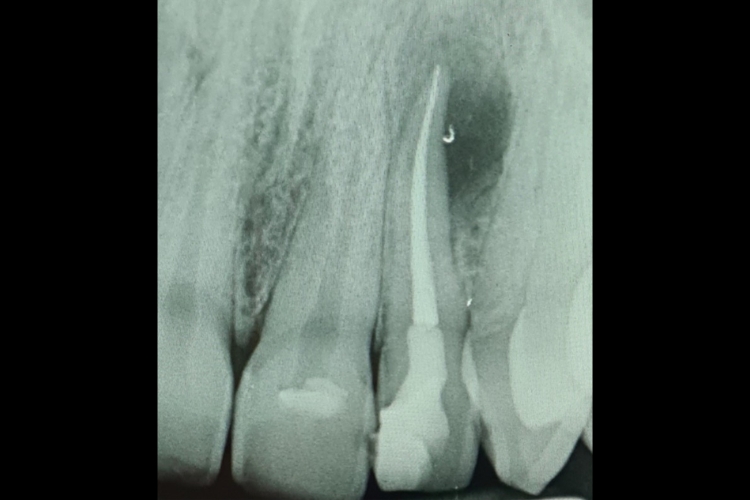 Root Canal Treatment
