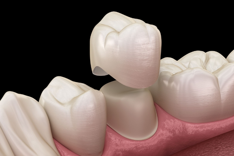 What is a tooth crown?