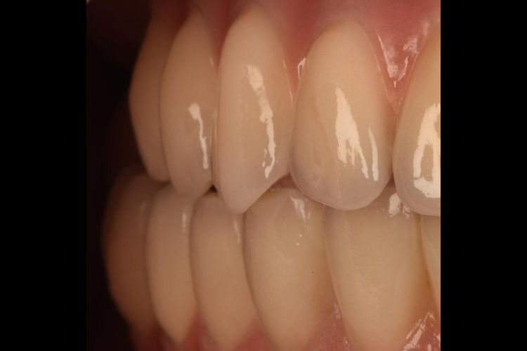 A Comprehensive Guide to Dental Implants in Stafford