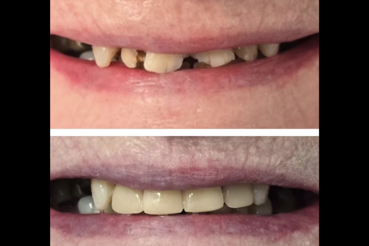 Saturday Morning Composite Bonding