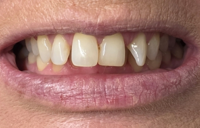 Cosmetic Bonding - Case 1 - Before