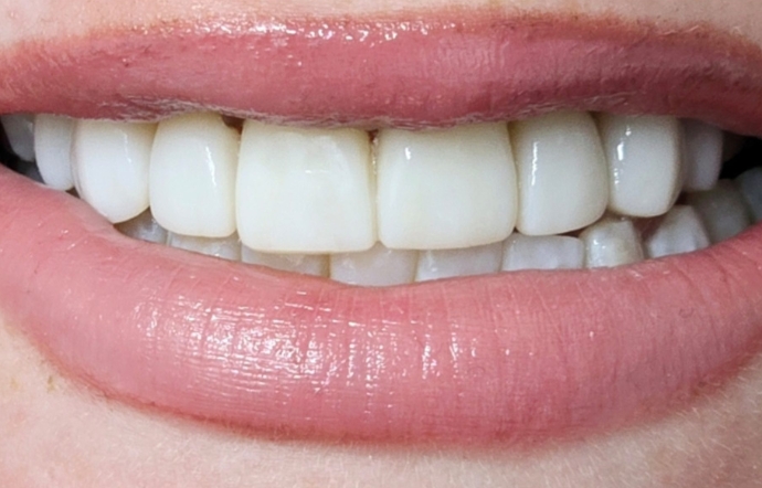 Cosmetic Bonding - Case 2 - After