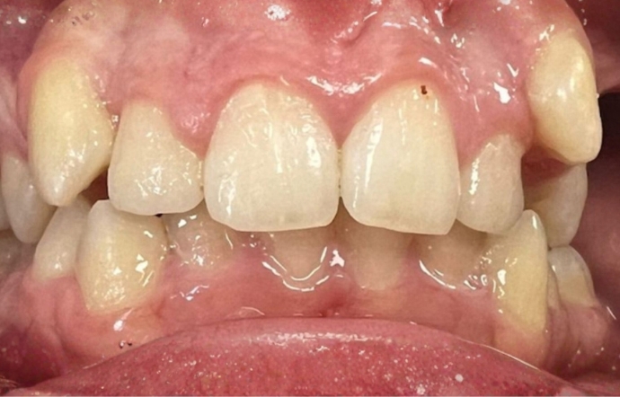 Invisalign - Case 1 - Before