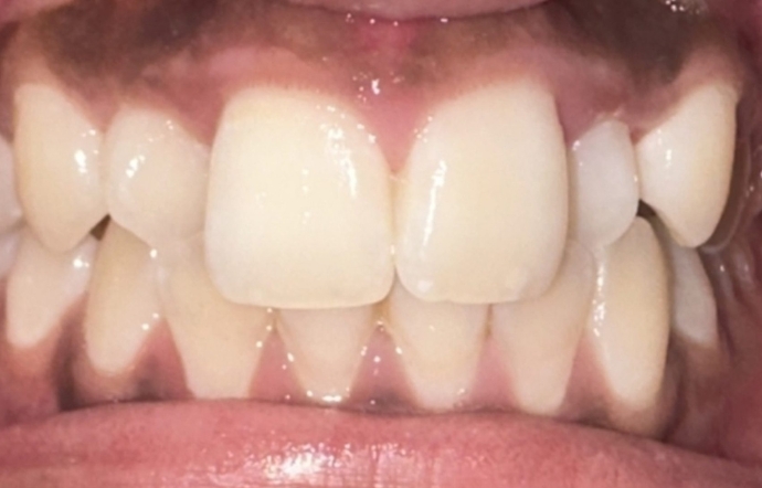 Porcelain Veneers and Clear Braces - Case 3 - before