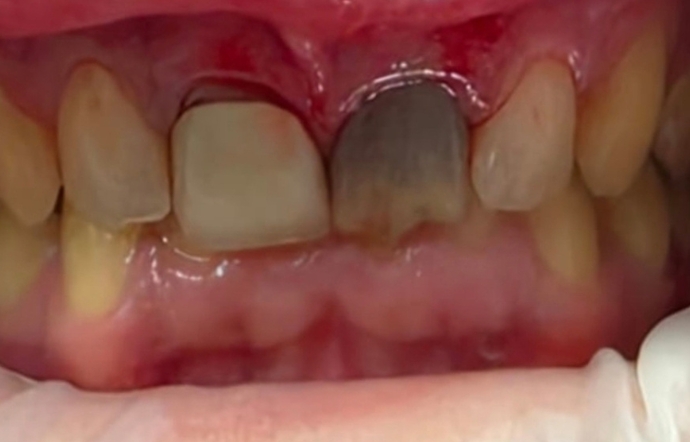 Smile Makeover - Case 2 - before