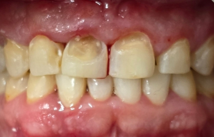 Cosmetic Bonding - Case 3 - Before