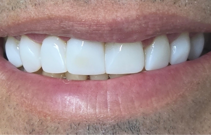 Cosmetic Bonding - Case 3 - After