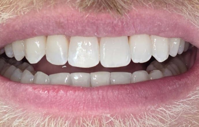 Invisalign - Case 2 - after