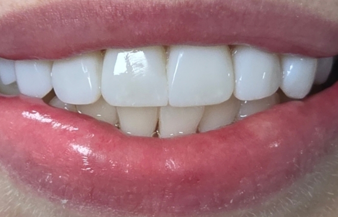 Porcelain Veneers - Case 1 - after