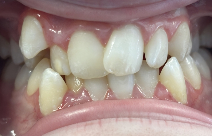 Braces - Case 1 - before