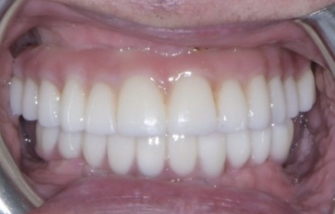 Dental implants - Case 1 - after
